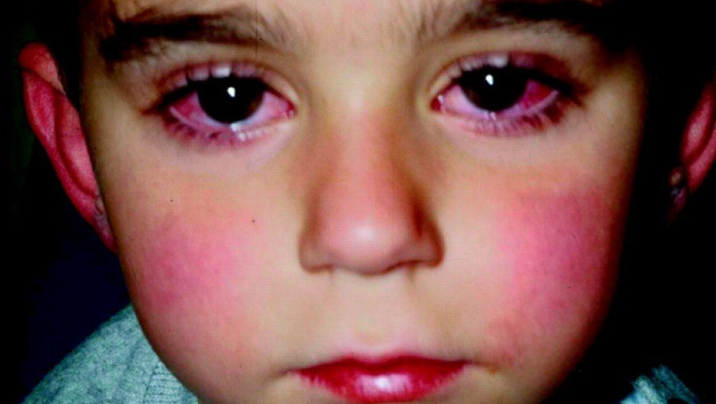 Νόσος Kawasaki: Τι είναι και ποιες οι επιπλοκές της