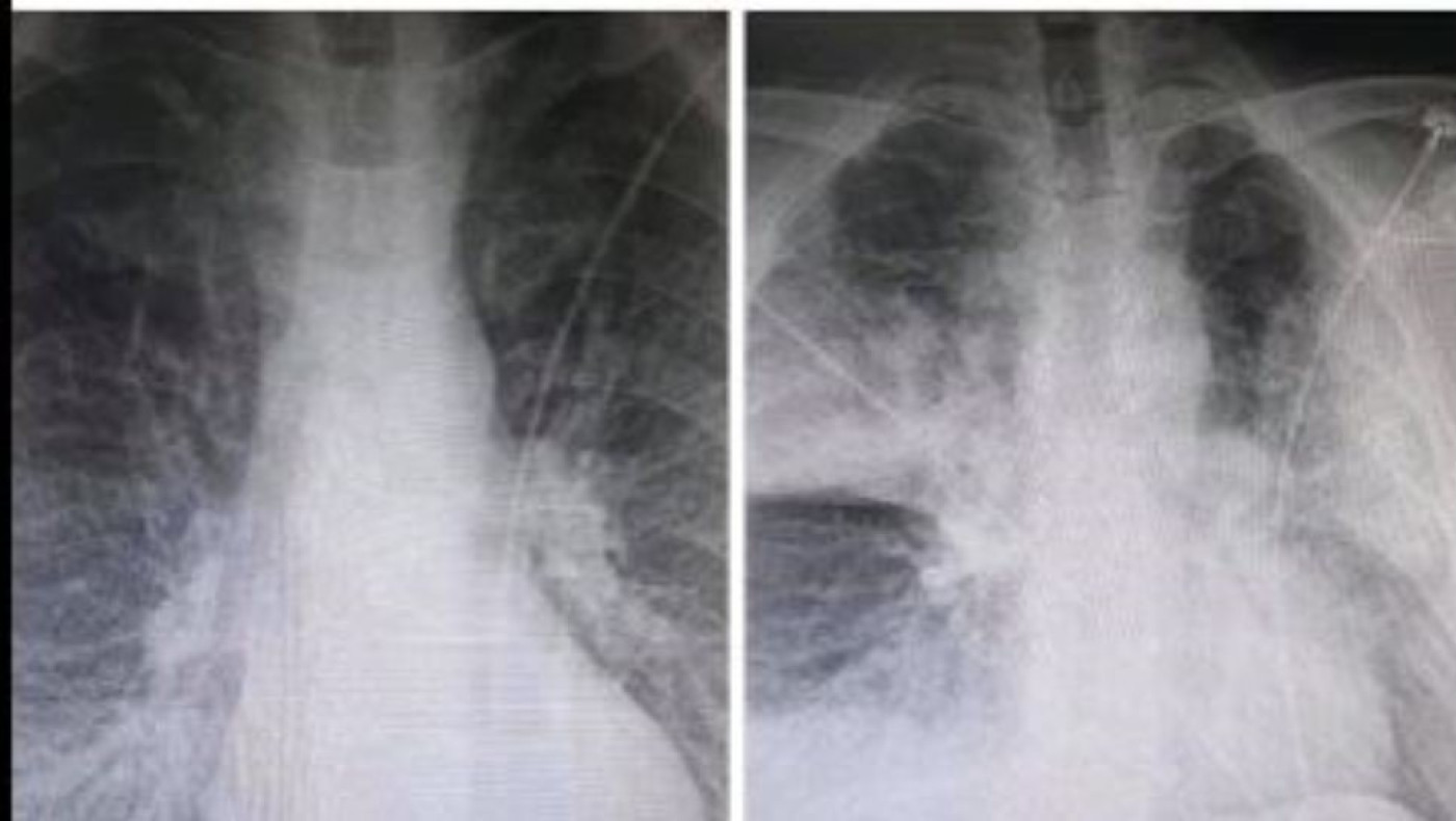 Πνευμονολόγος εξηγεί την ακτινογραφία του 38χρονου με κορωνοϊό