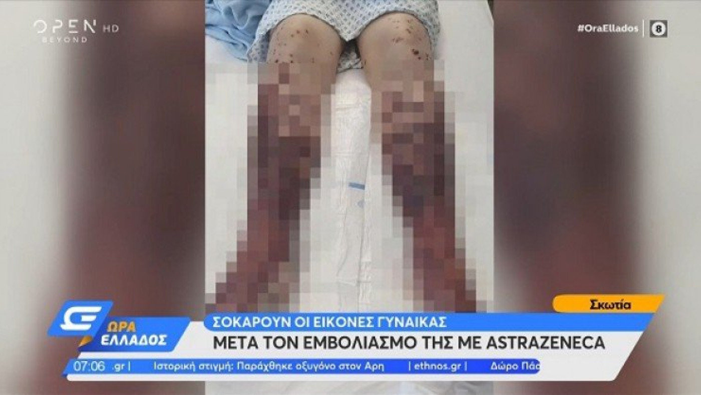Σκωτία: Σοκάρει η εικόνα γυναίκας μετά τον εμβολιασμό με AstraZeneca