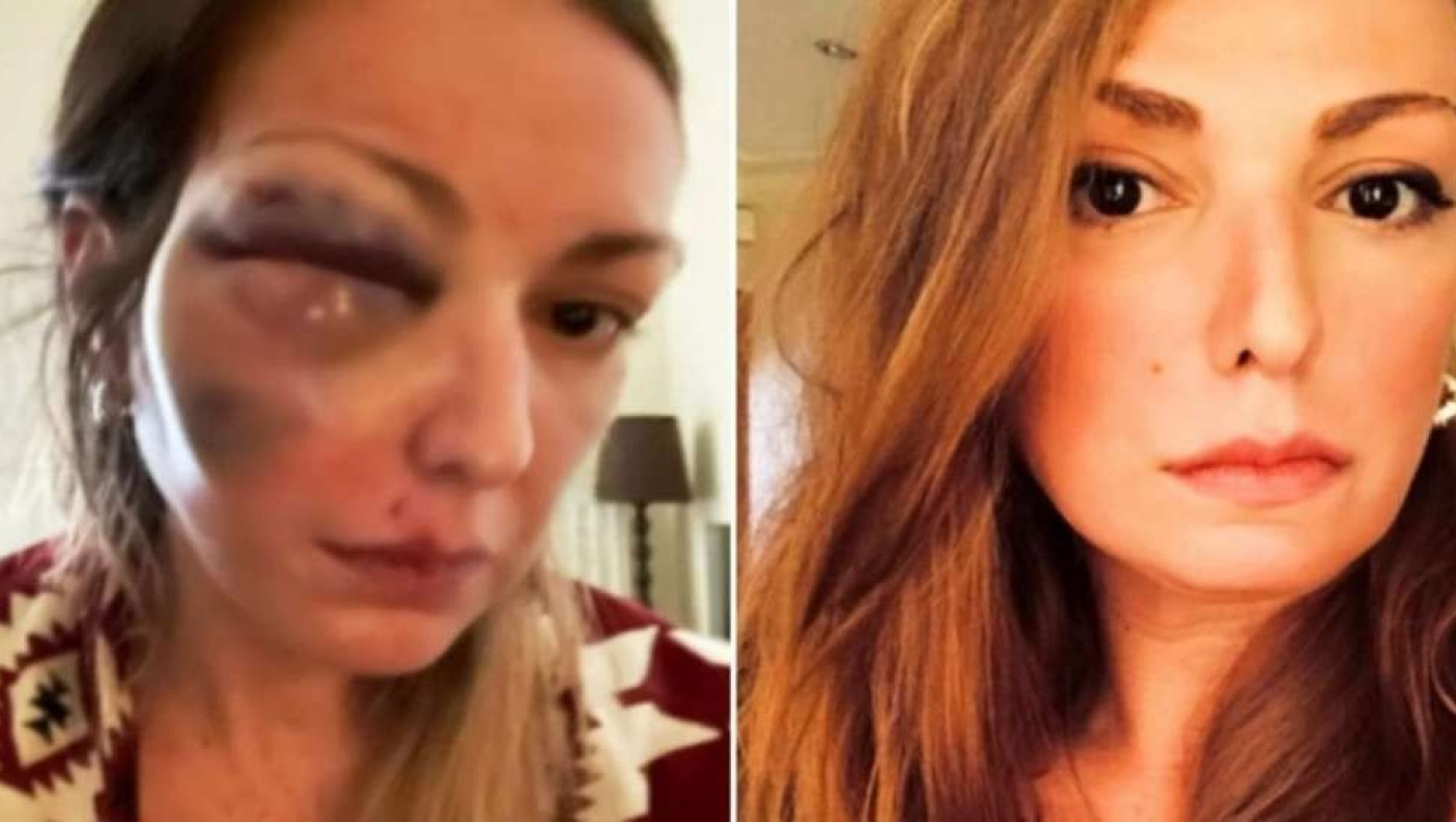 Γνωστή blogger έπεσε θύμα άγριας κακοποίησης και το twitter ξεσηκώθηκε