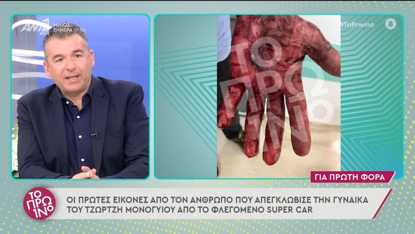 Σοκάρουν τα εγκαύματα του ανθρώπου που απεγκλώβισε τον Μονογυιό και τη γυναίκα του