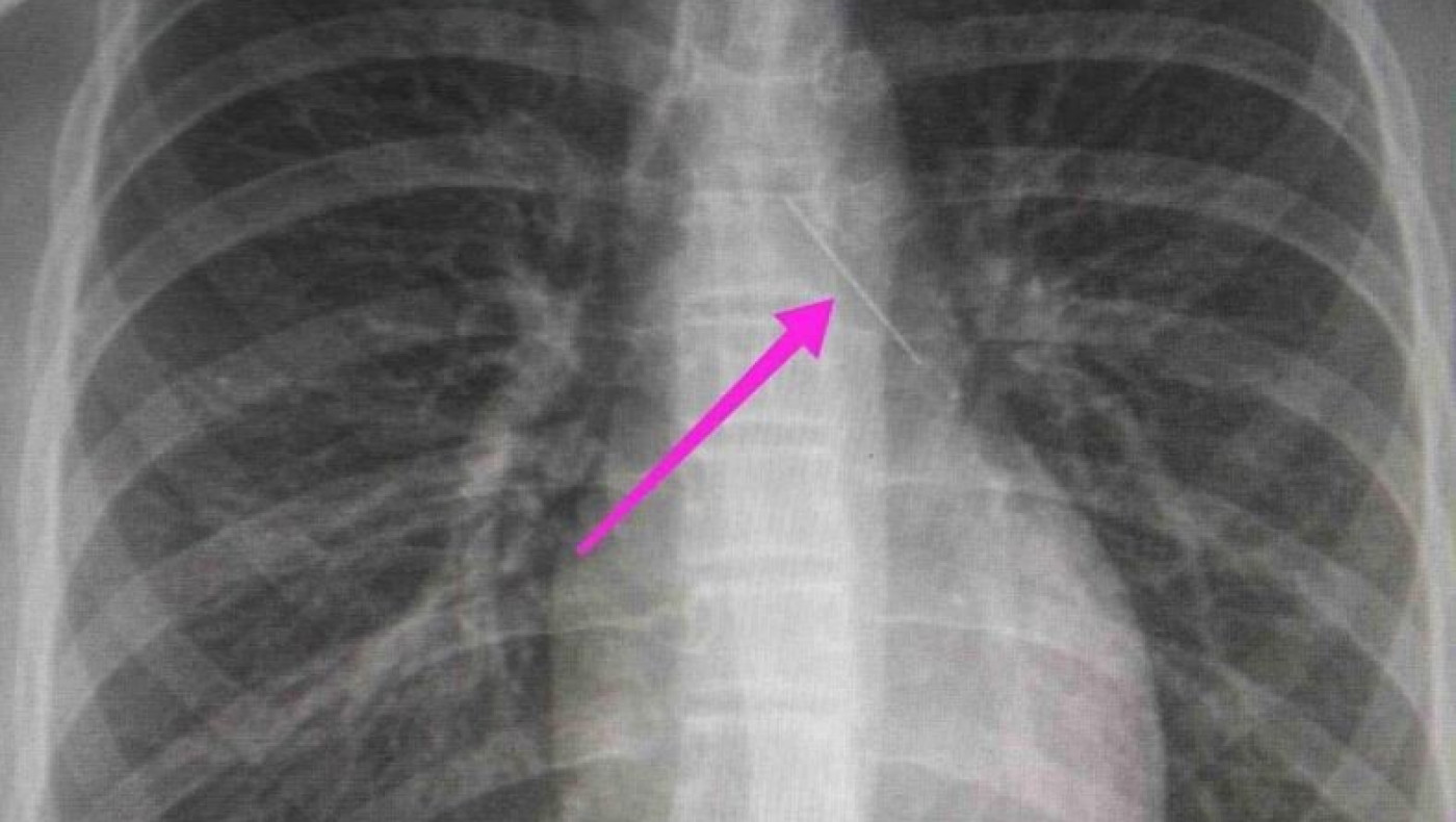 Θεσσαλονίκη: Ανήλικη κατάπιε καρφίτσα