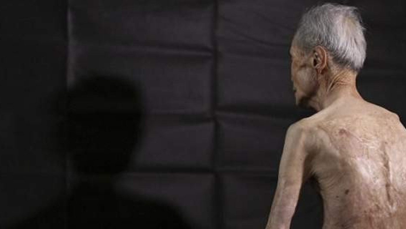 Τα σημάδια της ατομικής βόμβας - Επιζών δείχνει για πρώτη φορά τα εγκαύματα του!