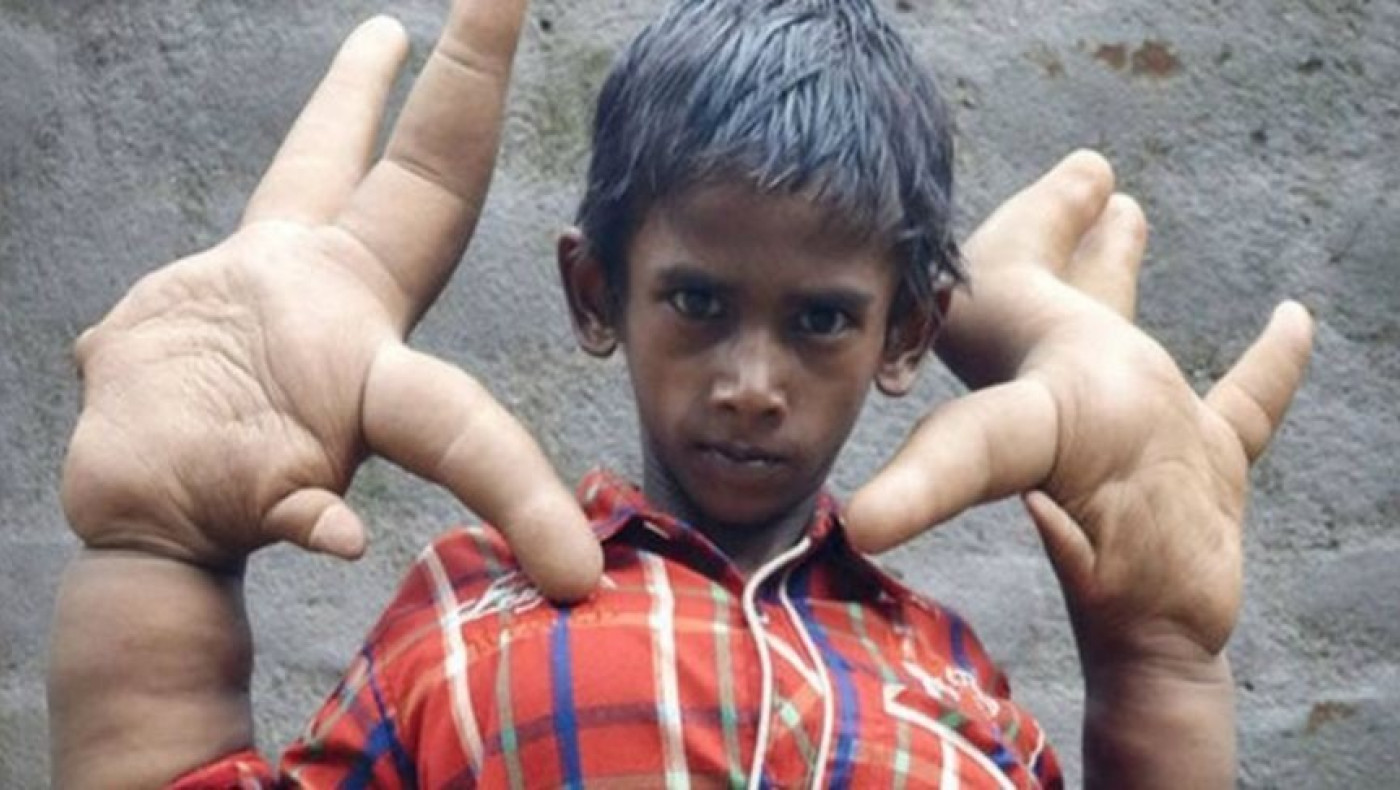 Το αγόρι με τα μεγαλύτερα χέρια στον κόσμο