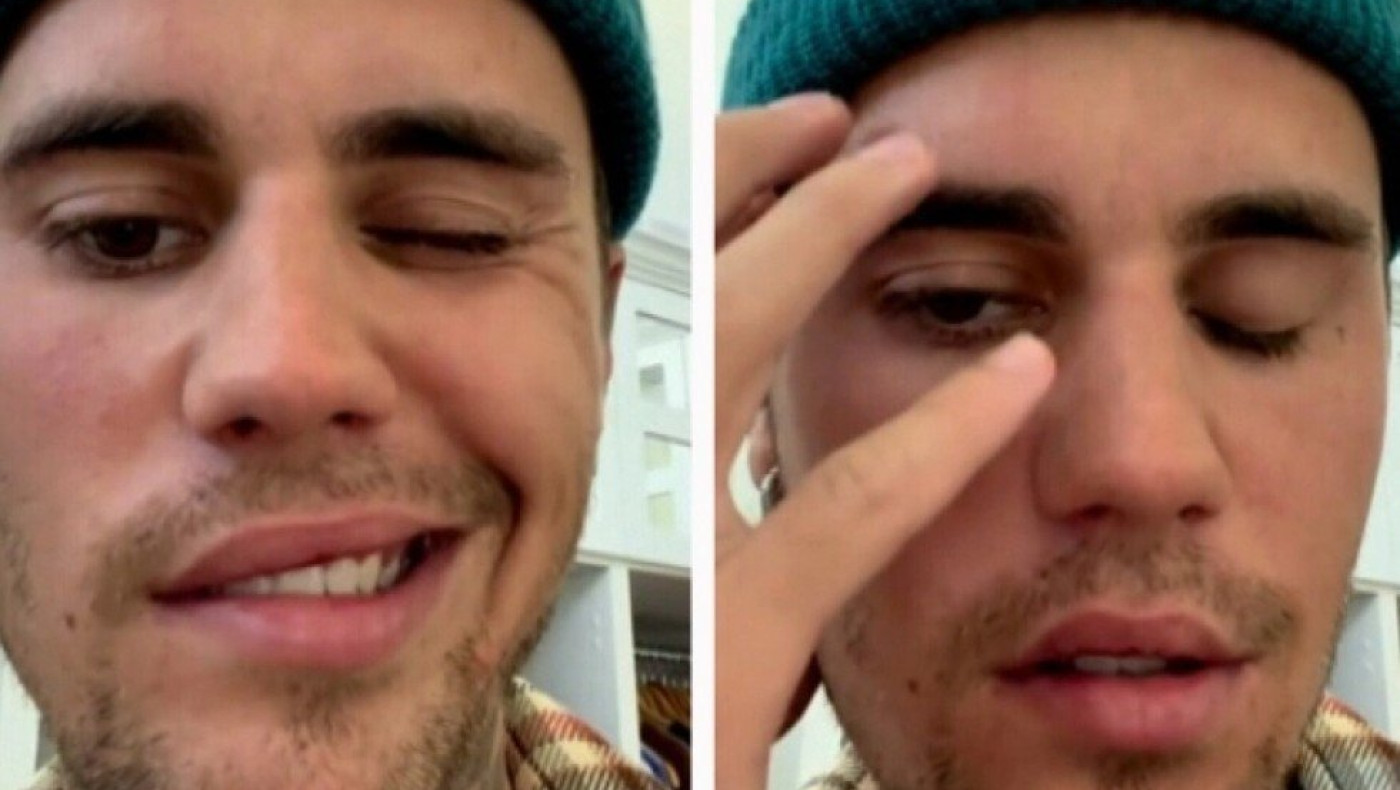 Ο Τζάστιν Μπίμπερ ανακοίνωσε ότι παρέλυσε το μισό του πρόσωπο