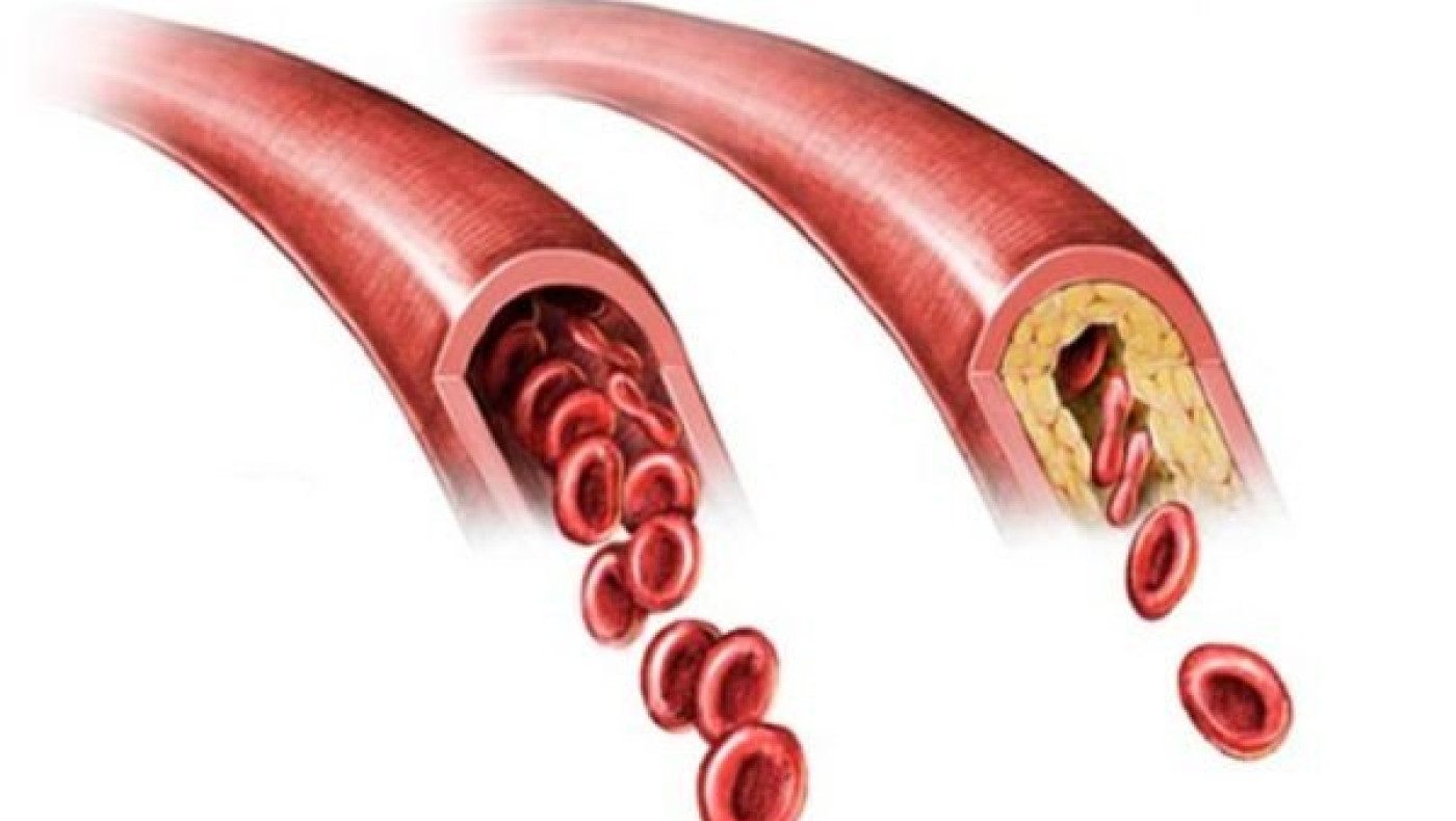 Οικογενής υπερχοληστερολαιμία: Μόνο το 20% των ασθενών γνωρίζει ότι πάσχει