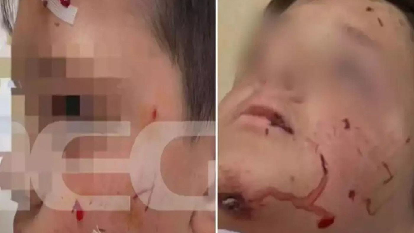 Στιγμές τρόμου για 13χρονο με άγρια επίθεση από σκύλο στο Λαγονήσι