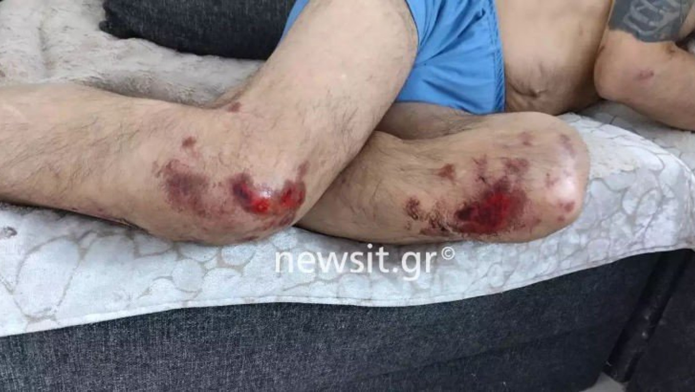 Νέα Φιλαδέλφεια: Σοκαριστικές εικόνες τραυματία φίλου της ΑΕΚ-Ζητά αποζημίωση από το κράτος