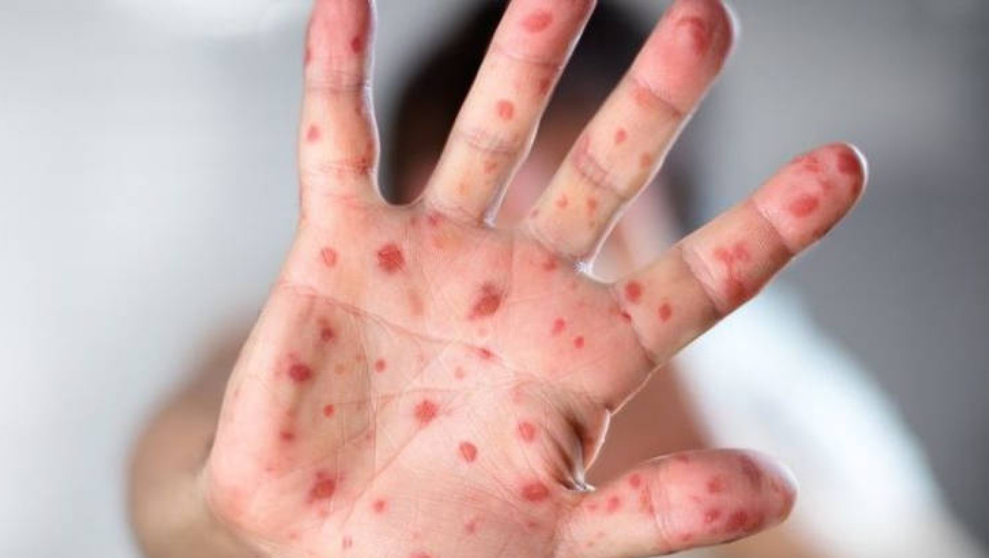 Ιλαρά: SOS μετά τα 5 επιβεβαιωμένα κρούσματα – Οι επικίνδυνες χώρες «εστίες» για τους ταξιδιώτες