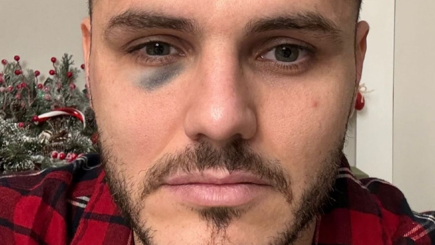 Διαμάχη Γαλατά - Φενέρ για το μαυρισμένο μάτι του Ικάρντι