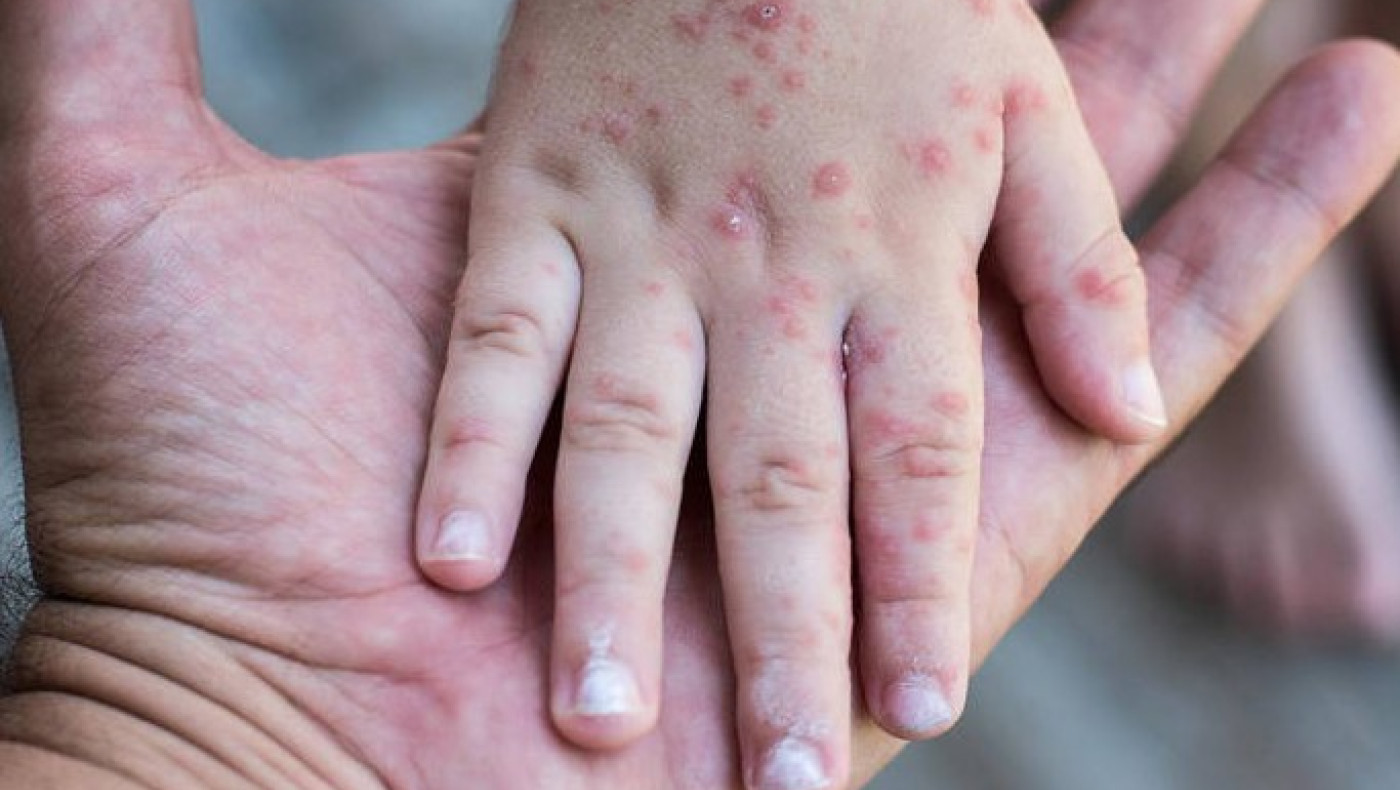 ΠΟΥ: Παγκόσμια ανησυχία για την ιλαρά-Αλματώδης αύξηση των κρουσμάτων στην Ευρώπη