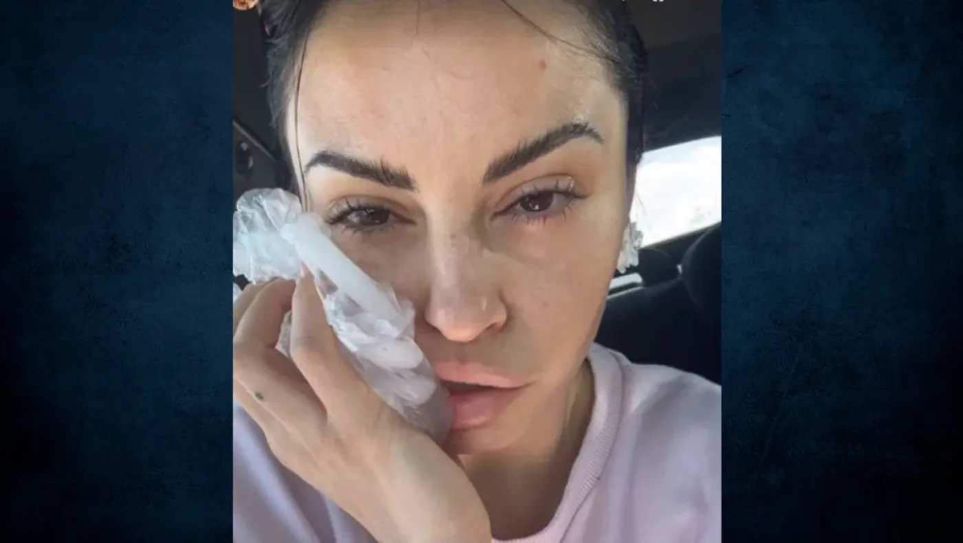 Ατύχημα στον δρόμο έπαθε η Δήμητρα Αλεξανδράκη-«Προσγειώθηκε η μπάρα στο κεφάλι μου»