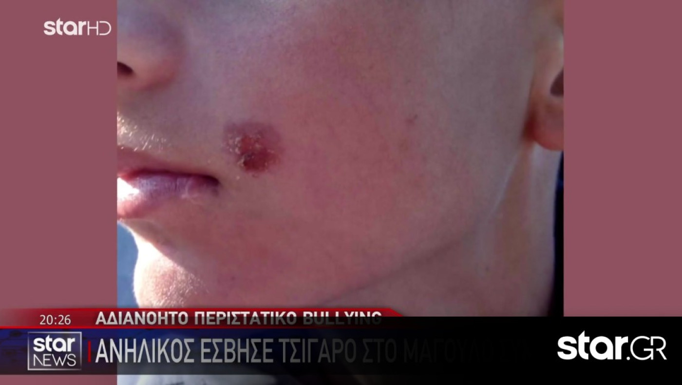 Πέλλα: Ανήλικος έσβησε τσιγάρο στο μάγουλο συμμαθητή του (vid)