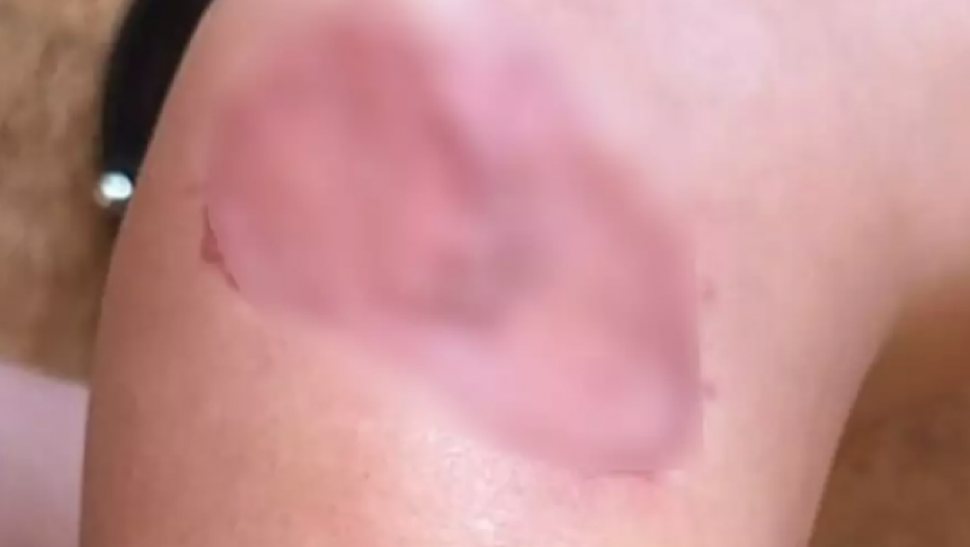 Γνωστή influencer πήγε για πλαστική στήθους και παραλίγο να της ακρωτηριάσουν το πόδι