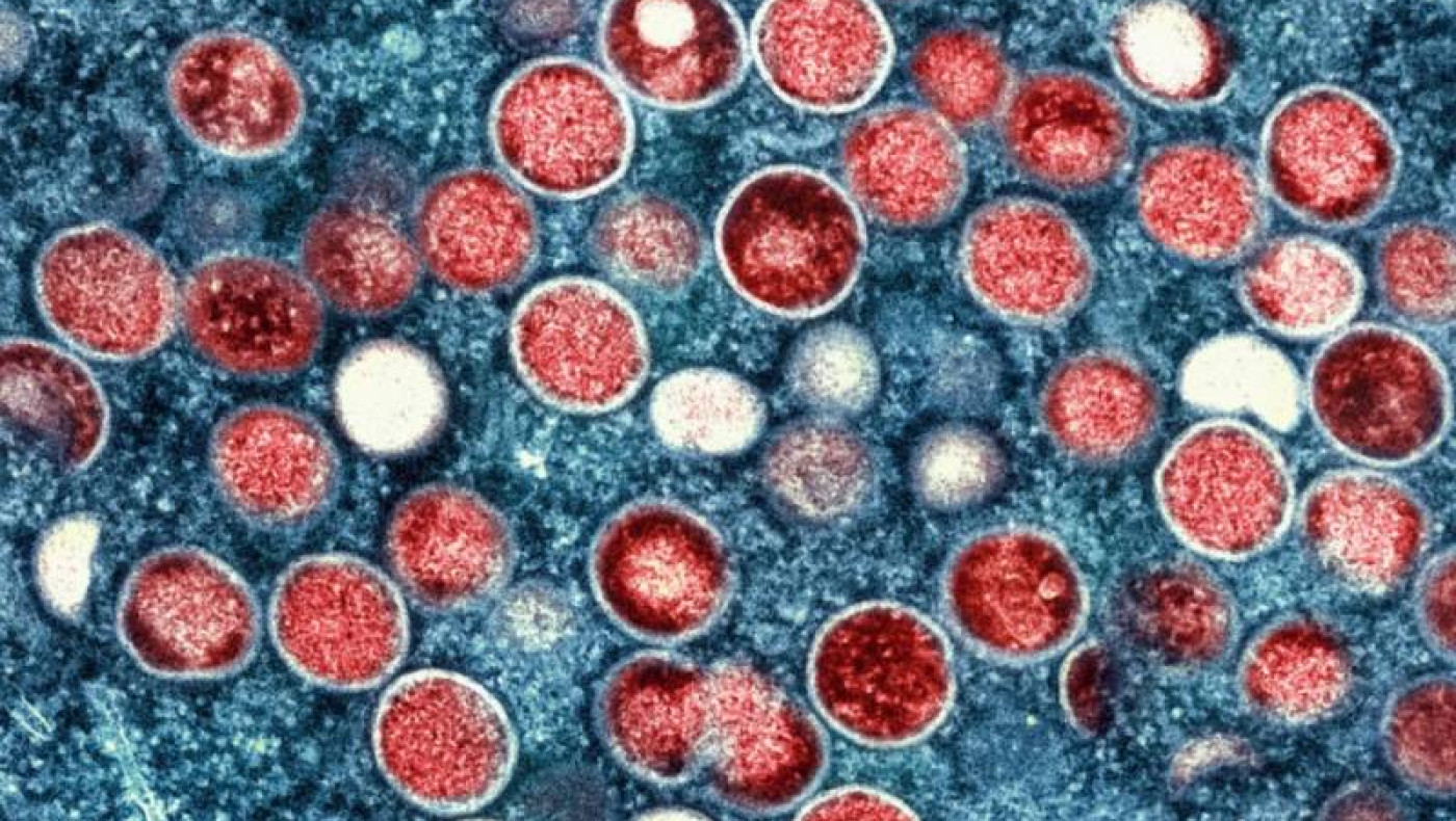 Ευλογιά των πιθήκων: Σε ετοιμότητα οι υγειονομικές αρχές