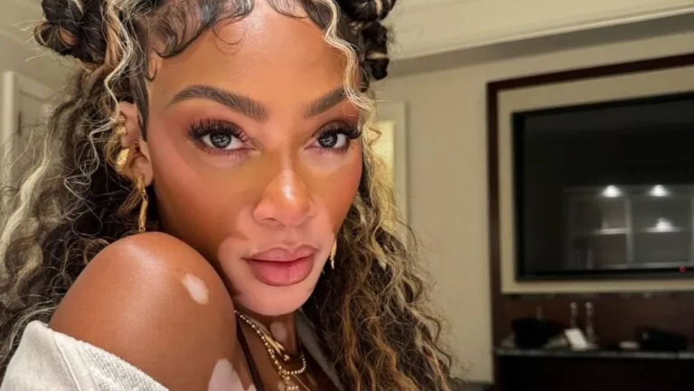 Winnie Harlow: Η πρέσβειρα των γυναικών με λεύκη με «καυτό» μπικίνι