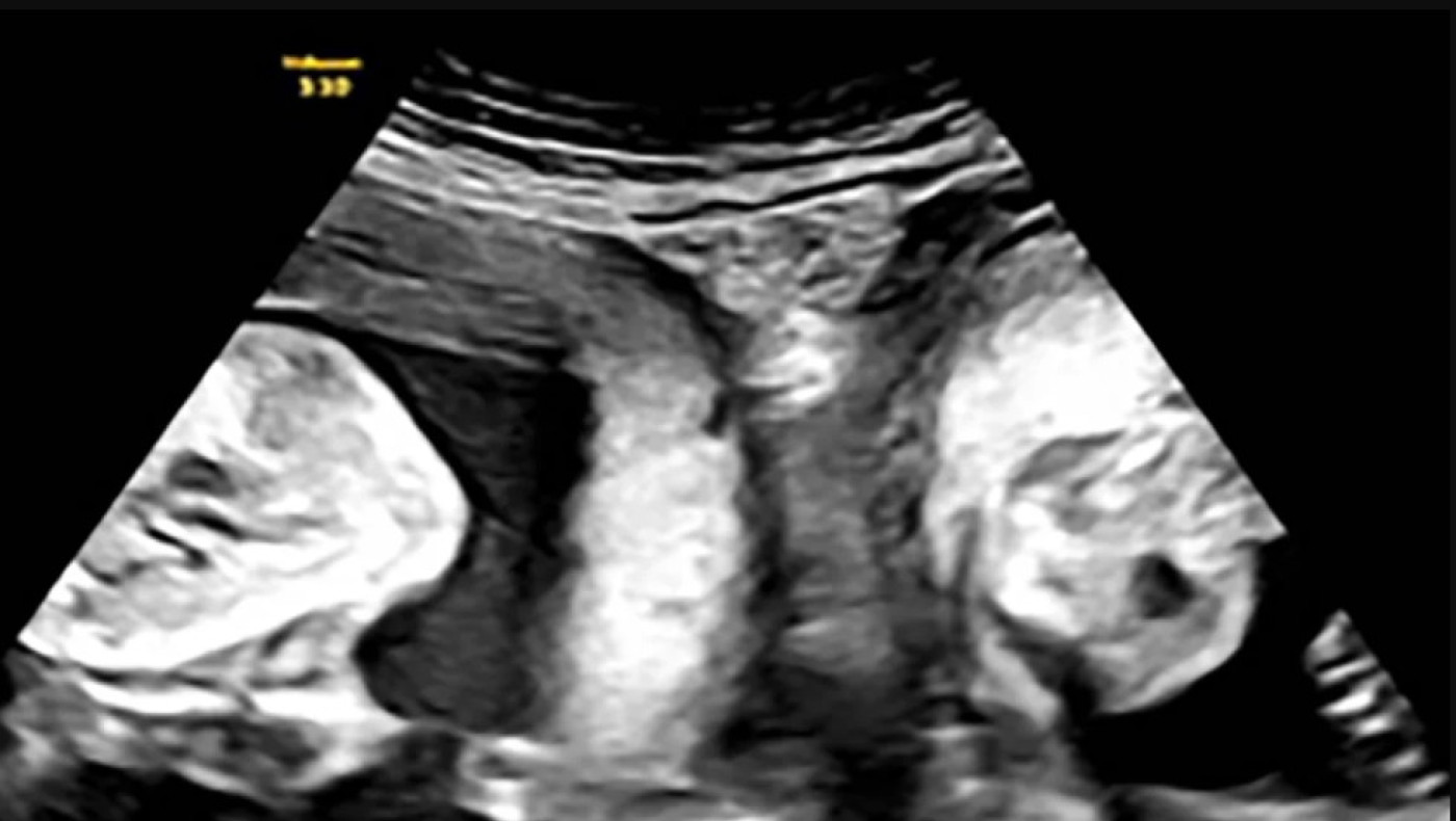 Ιατρικό θαύμα: Γυναίκα με δυο μήτρες γέννησε δίδυμα