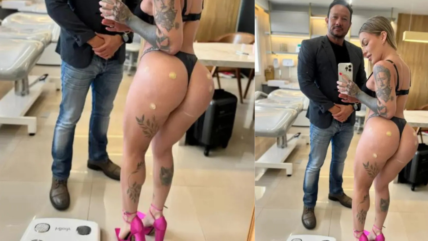Βραζιλιάνα influencer έπαθε κρυοπαγήματα στα οπίσθια