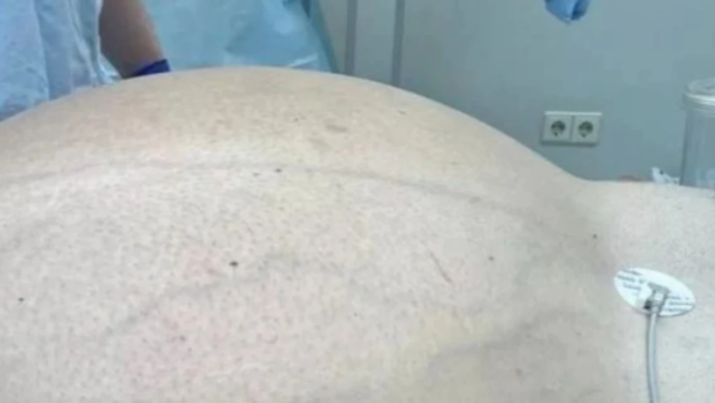 Αφαίρεση γιγάντιου όγκου 60 κιλών από 50χρονο