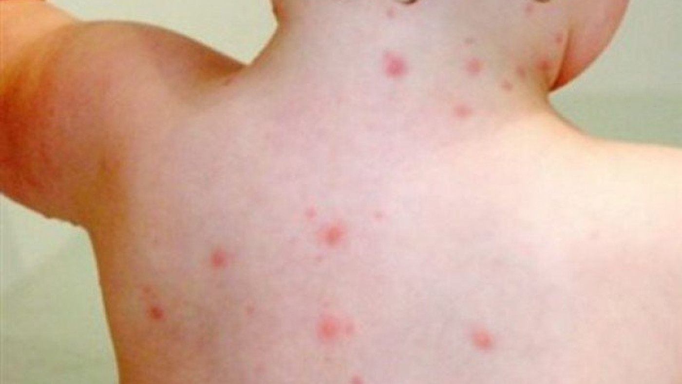 Βρέφος 11 μηνών το πρώτο θύμα της ιλαράς στην Ελλάδα