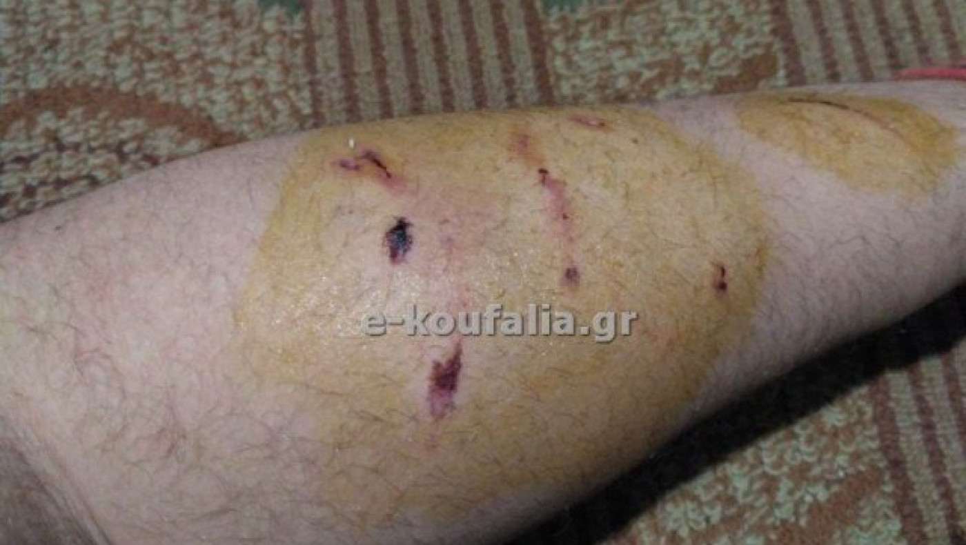 Θεσσαλονίκη: Σκυλί δάγκωσε και τραυμάτισε μαθητή στο Βαθύλακκο