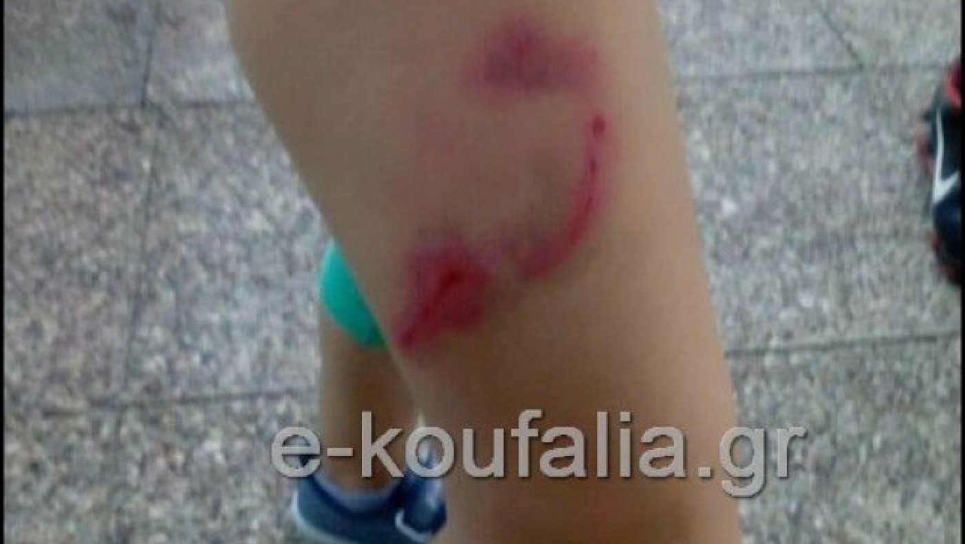 Θεσσαλονίκη: Σκυλιά επιτέθηκαν σε 7χρονη στα Κουφάλια (ΦΩΤΟ)