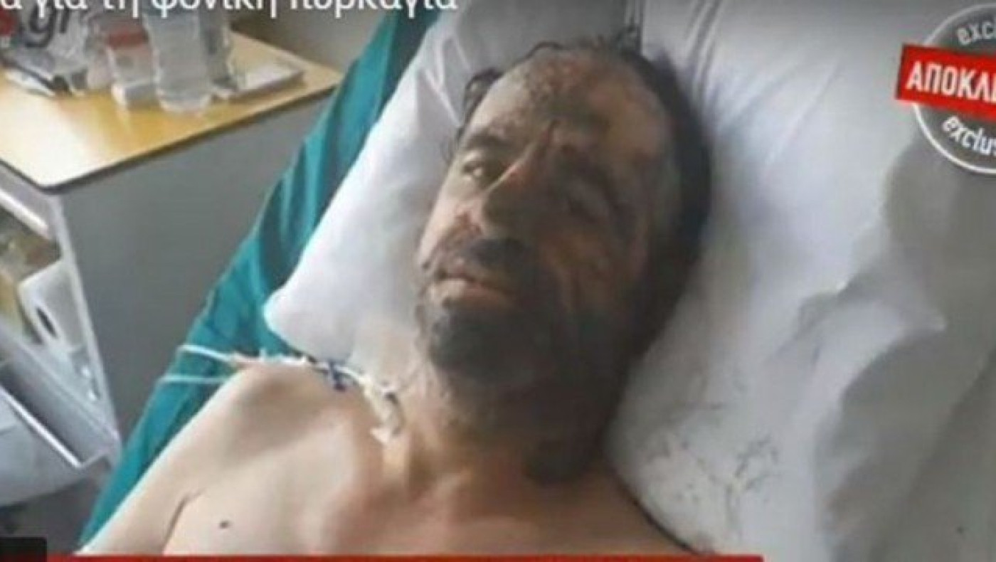 Συγκλονίζει η μαρτυρία εγκαυματία: «Η φωτιά έτρεχε σαν δαιμονισμένη!»