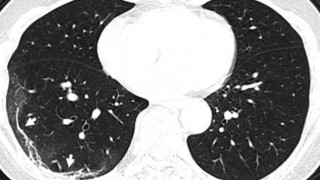 Κορωνοϊός: Ανατριχιαστική ακτινογραφία ασθενούς