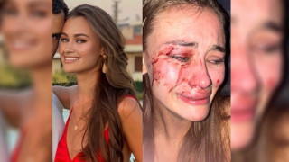 Διάσημο μοντέλο απο Ουκρανία: Με ξυλοκόπησαν στην Τουρκία