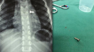 Κρήτη: Τρίχρονο κοριτσάκι κατάπιε βίδα που κατέληξε στον πνεύμονά του