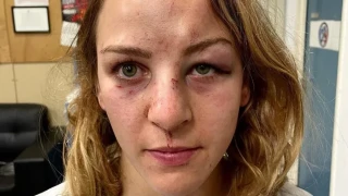 Ολυμπιονίκης παραμορφωμένη από τα χτυπήματα του συντρόφου της -Ανέβασε φωτογραφία