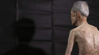 Τα σημάδια της ατομικής βόμβας - Επιζών δείχνει για πρώτη φορά τα εγκαύματα του!