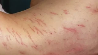 64χρονος είχε εξάνθημα και αποδείχτηκε ότι ήταν σκουλήκια που μεγάλωναν κάτω από το δέρμα του