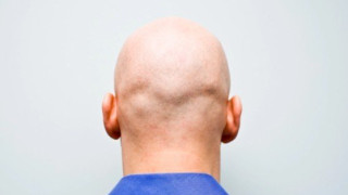 Απόφαση σταθμός για την φαλάκρα στην Βρετανία!