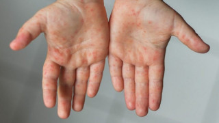 Γρίπη της τομάτας: Μυστηριώδης ασθένεια που πλήττει παιδιά εξαπλώνεται στην Ινδία