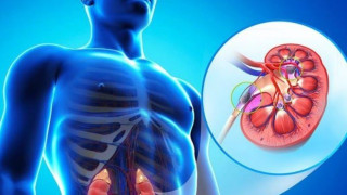 Πέτρες στα νεφρά: Το μυστικό για να αποφύγουμε τις υποτροπές