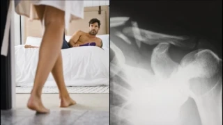 Απίστευτο ιατρικό περιστατικό: Έσπασε σε τρία σημεία το μόριό του κατά την διάρκεια ερωτικής πράξης