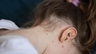 Επιδημία ιλαράς στη Ρουμανία