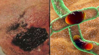 Τι είναι η νόσος του άνθρακα-Γιατί λέγεται «μαύρη κατάρα»