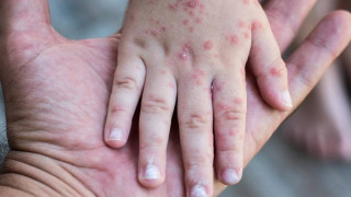 ΠΟΥ: Παγκόσμια ανησυχία για την ιλαρά-Αλματώδης αύξηση των κρουσμάτων στην Ευρώπη