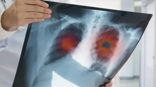 Δραματική πρόβλεψη του ΠΟΥ: Πάνω από 75% αύξηση των καρκίνων έως το 2050