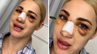 Ιωάννα Τούνη: Δύσκολη η αποθεραπεία από την πλαστική στη μύτη