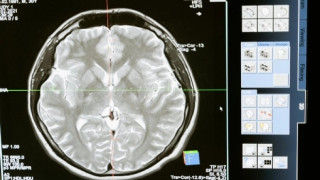 «Οι ανθρώπινοι εγκέφαλοι μεγαλώνουν»: Τι σημαίνει αυτό για την ανθρωπότητα