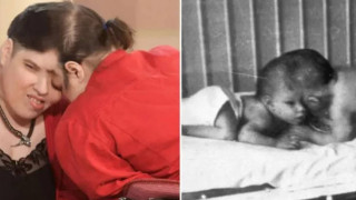 ΗΠΑ: Πέθαναν τα μεγαλύτερα σε ηλικία σιαμαία-Είχαν μπει στο βιβλίο Γκίνες