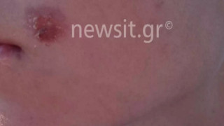 Σκύδρα: 15χρονος έσβησε τσιγάρο στο μάγουλο συμμαθητή του