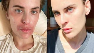 Ταλούλα Γουίλις: Συγκλονίζει με την αποκάλυψη ότι πάσχει από δερματιλλομανία