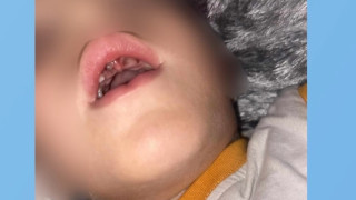 Του έσπασαν τα δόντια και είπαν ότι... σκόνταψε - Τριετής η διάρκεια θεραπείας