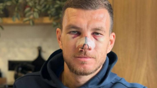 Έντιν Τζέκο: Φωτογραφήθηκε με τα σημάδια της κλωτσιάς στο πρόσωπο