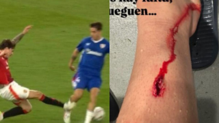 Europa League: Το σημάδι στο πόδι του Πράντος