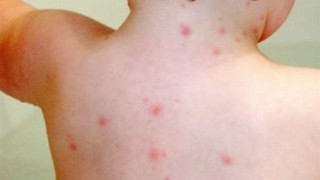 Βρέφος 11 μηνών το πρώτο θύμα της ιλαράς στην Ελλάδα